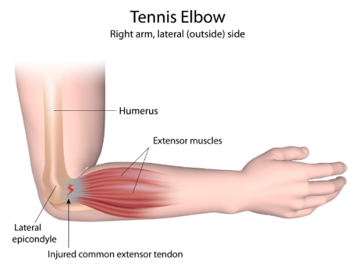 Golfers elbow pain