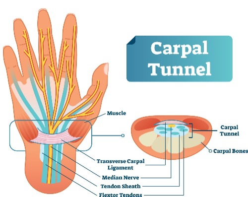 Carpal tunnel physio